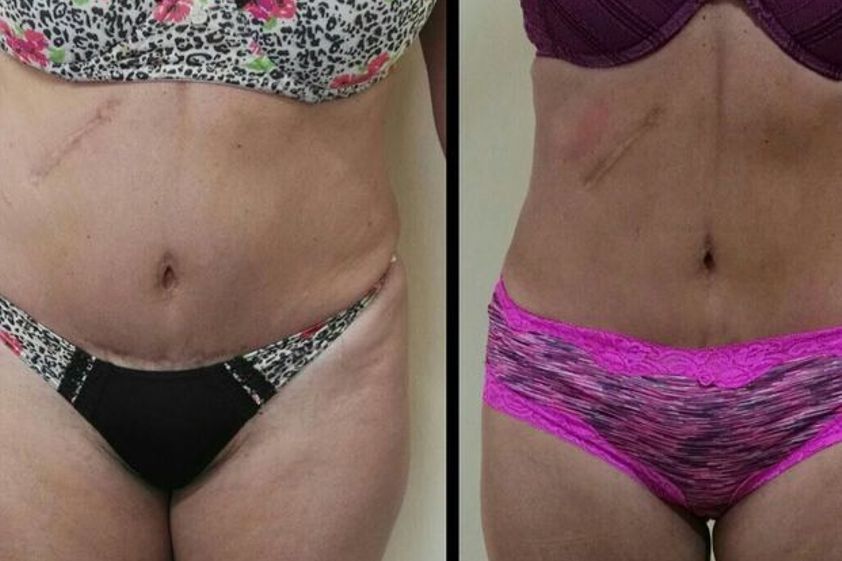 Criolipólisis antes y después - 623477