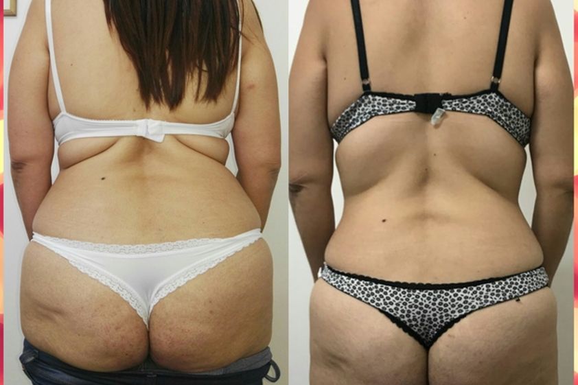 Criolipólisis antes y después - 625904
