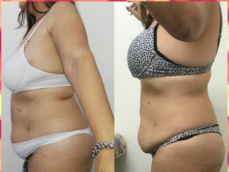 criolipolisis antes y despues criolipolisis antes y despues