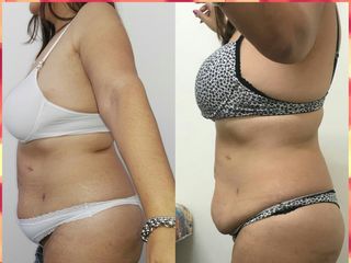 Criolipolisis de abdomen 