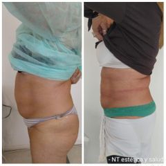 Liposucción - Dra. Torrijos Noelia