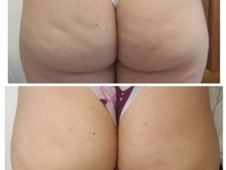 Tratamientos celulitis antes y después - 800871