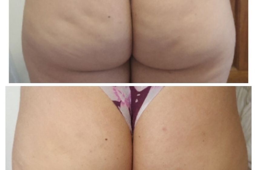 Tratamientos celulitis antes y después - 800871