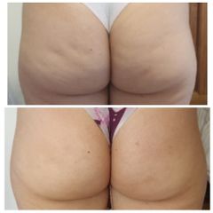 Tratamiento celulitis - Dra. Torrijos Noelia