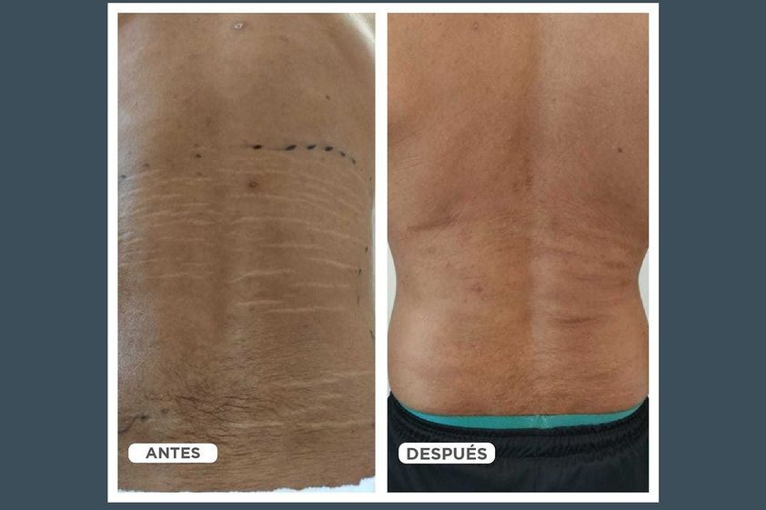 Tratamientos para estrías antes y después - 858939