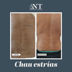 Tratamiento para estrías - Dra. Torrijos Noelia