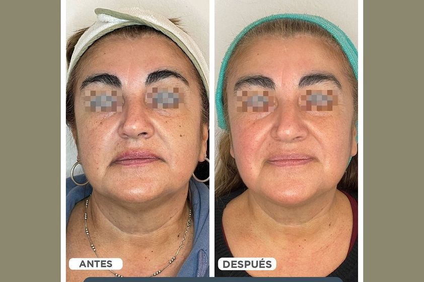 Manchas de la piel antes y después - 858942