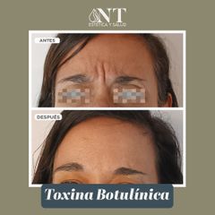 Toxina Botulínica - Dra. Torrijos Noelia