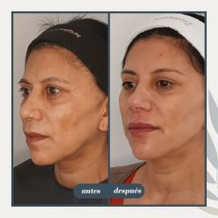Rellenos faciales - Dra. Torrijos Noelia