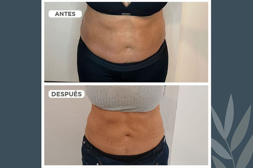 HIFU antes y después - 858974
