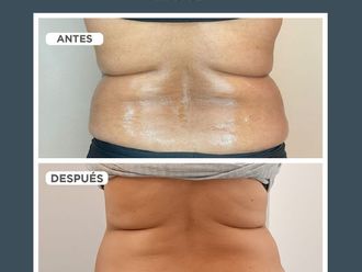 HIFU antes y después - 858975