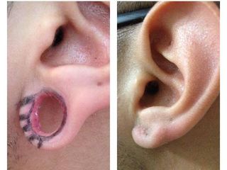 Antes y despues de Reparacion del lóbulo de la oreja