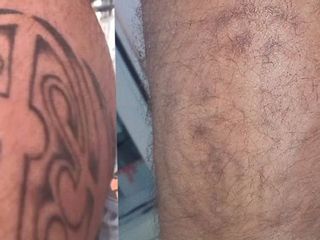 Antes y despues de eliminacion de tatuajes