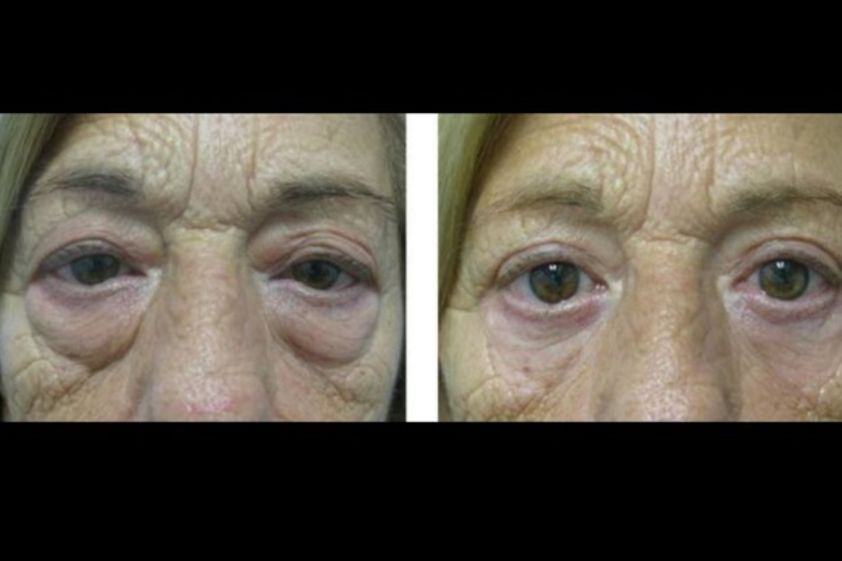 Blefaroplastia antes y después - 595911