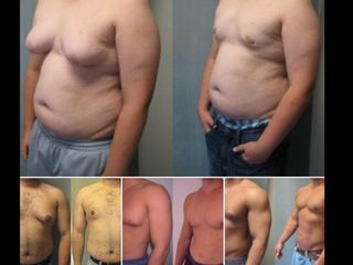 Abdominoplastia
