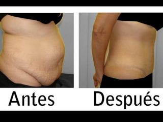 Abdominoplastia