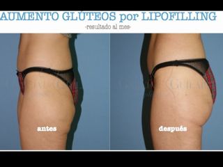Aumento de glúteos