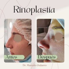 Rinoplastia - Dr. Marcelo Federico Guijarro