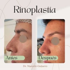 Rinoplastia - Dr. Marcelo Federico Guijarro