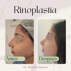 Rinoplastia - Dr. Marcelo Federico Guijarro