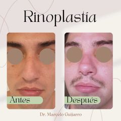 Rinoplastia - Dr. Marcelo Federico Guijarro