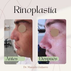 Rinoplastia - Dr. Marcelo Federico Guijarro