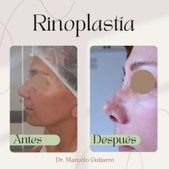 Rinoplastia - Dr. Marcelo Federico Guijarro