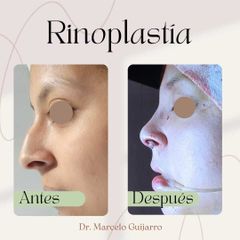 Rinoplastia - Dr. Marcelo Federico Guijarro