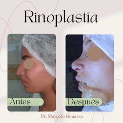 Rinoplastia - Dr. Marcelo Federico Guijarro