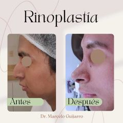 Rinoplastia - Dr. Marcelo Federico Guijarro