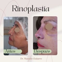 Rinoplastia - Dr. Marcelo Federico Guijarro