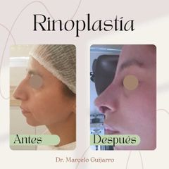 Rinoplastia - Dr. Marcelo Federico Guijarro