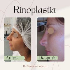 Rinoplastia - Dr. Marcelo Federico Guijarro