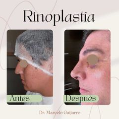 Rinoplastia - Dr. Marcelo Federico Guijarro