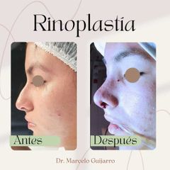 Rinoplastia - Dr. Marcelo Federico Guijarro