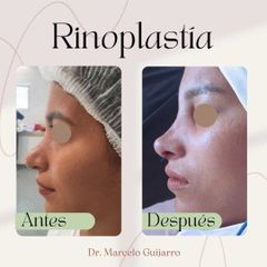 Rinoplastia - Dr. Marcelo Federico Guijarro