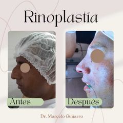 Rinoplastia - Dr. Marcelo Federico Guijarro