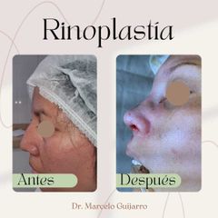 Rinoplastia - Dr. Marcelo Federico Guijarro