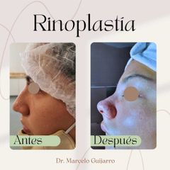 Rinoplastia - Dr. Marcelo Federico Guijarro