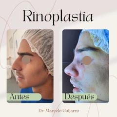 Rinoplastia - Dr. Marcelo Federico Guijarro