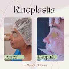 Rinoplastia - Dr. Marcelo Federico Guijarro