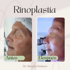 Rinoplastia - Dr. Marcelo Federico Guijarro