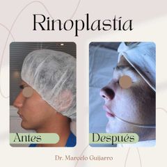 Rinoplastia - Dr. Marcelo Federico Guijarro