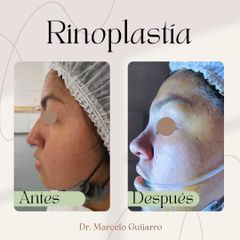 Rinoplastia - Dr. Marcelo Federico Guijarro