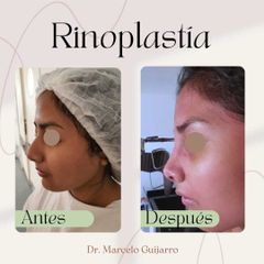 Rinoplastia - Dr. Marcelo Federico Guijarro