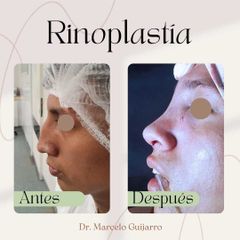 Rinoplastia - Dr. Marcelo Federico Guijarro