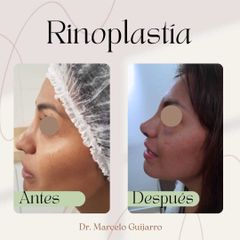 Rinoplastia - Dr. Marcelo Federico Guijarro