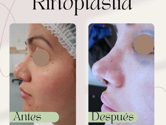 Rinoplastia antes y después - 869498