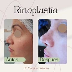 Rinoplastia - Dr. Marcelo Federico Guijarro