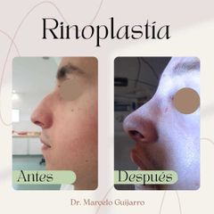 Rinoplastia - Dr. Marcelo Federico Guijarro